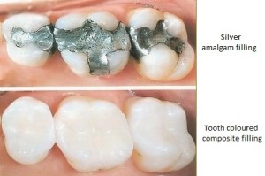 replace-mercury-fillings-holistic-dentistry