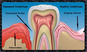 Holistic-dentistry-gum-disease