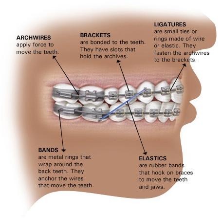 braces_diagram