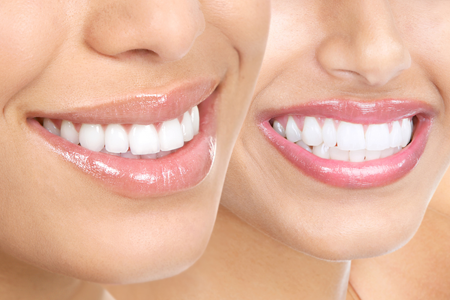 Get your perfect veneer smile from Integrative Dentistry, Seattle today!