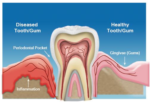 gum_disease