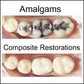 amalgam-filling-restoration