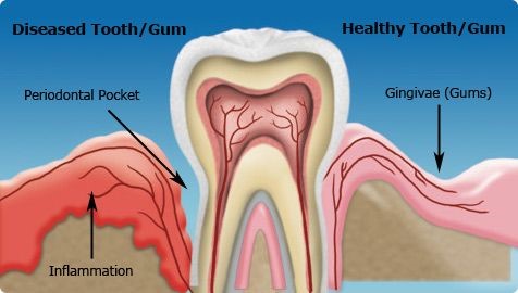 Seattle-holistic-dentistry-periodontal-disease-diabetes