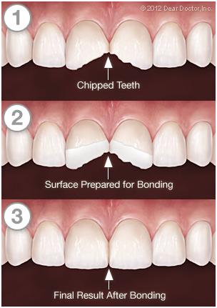 tooth-bonding-process